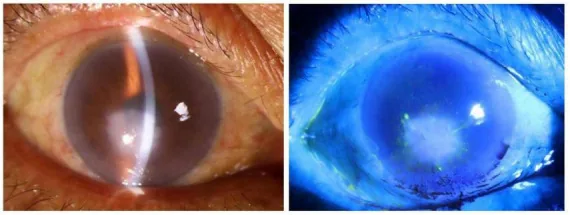 Interstitial Keratitis image