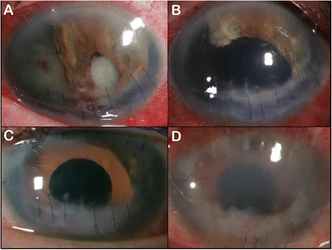 Iris Trauma Repair image