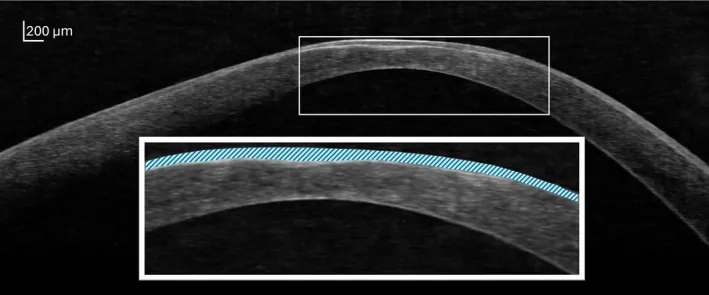 Keratoconus image