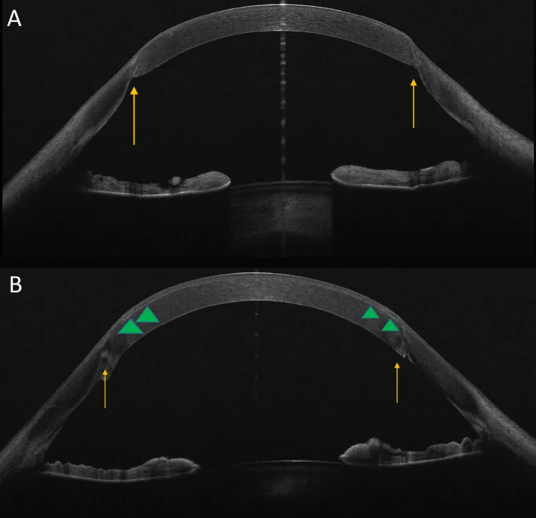 LASIK Surgery After Corneal Transplant image