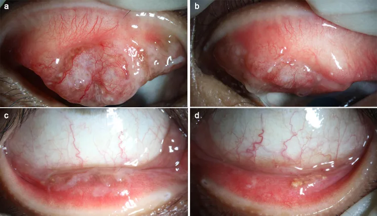 Ligneous Conjunctivitis image