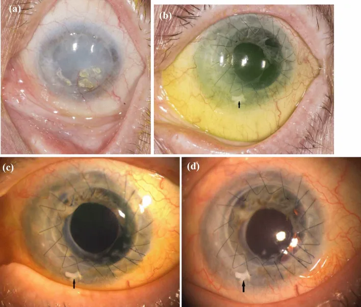 Limbal Stem Cell Deficiency image
