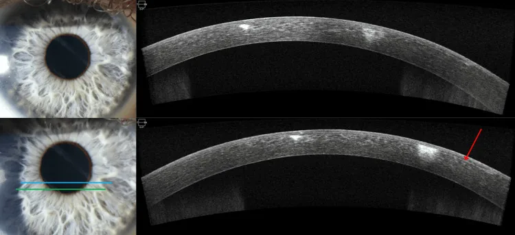 Linear Interstitial Keratitis image