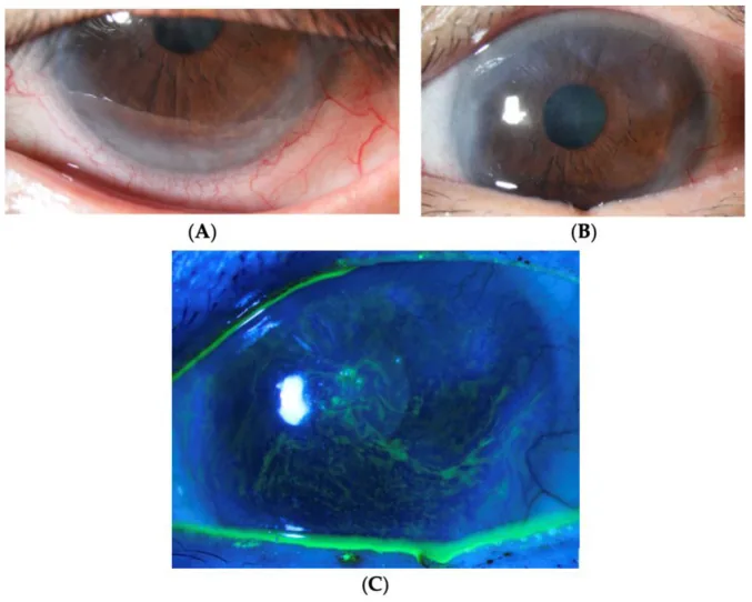 Living-related conjunctival limbal allograft _lr-C image
