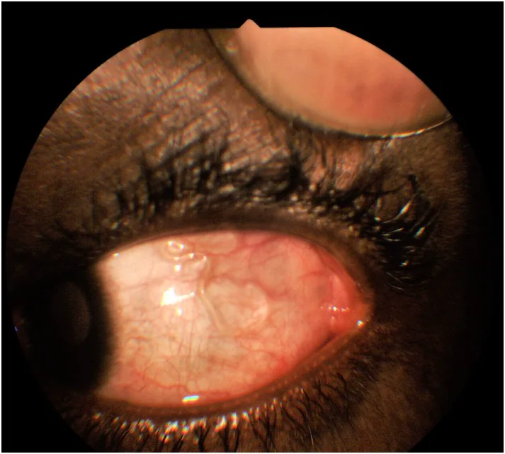 Loa Loa Filariasis African Eye Worm image