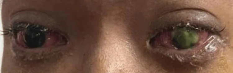 Membranous Conjunctivitis and Pseudomembranous Con image