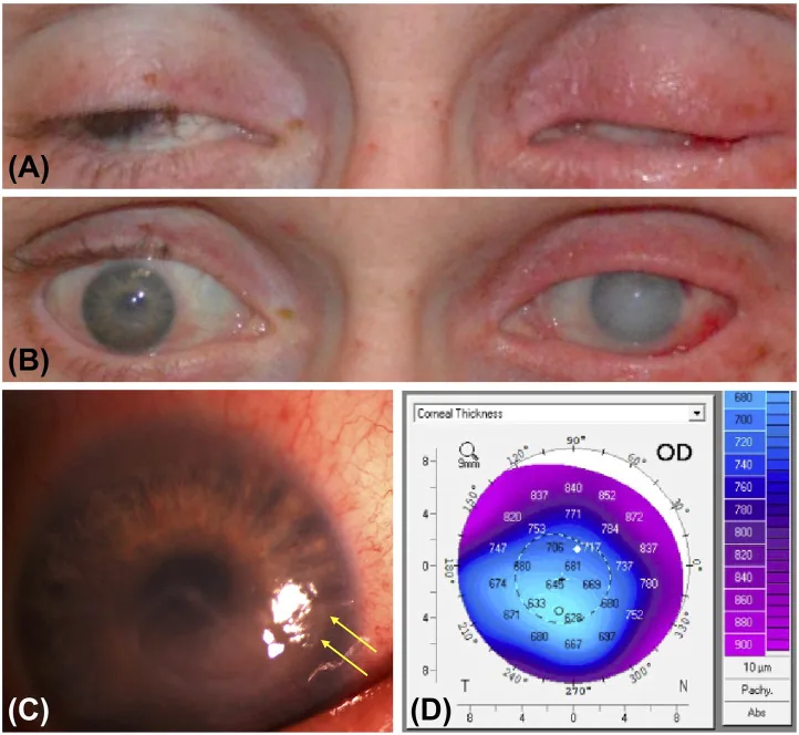 Methamphetamine-Induced Keratitis image
