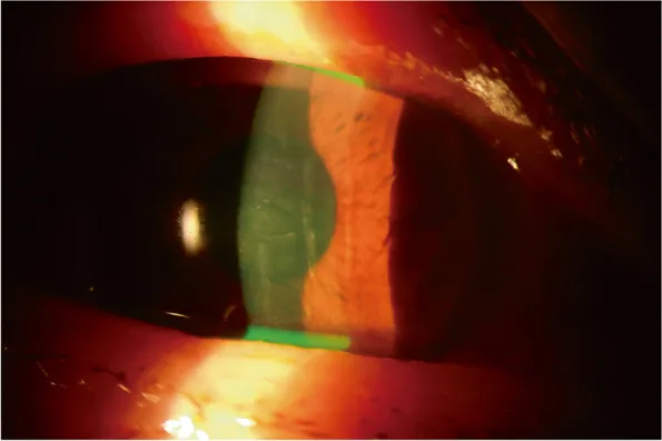 Milkweed Corneal Toxicity image