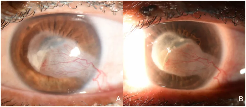 Mitomycin Intravascular Chemoembolization MICE image