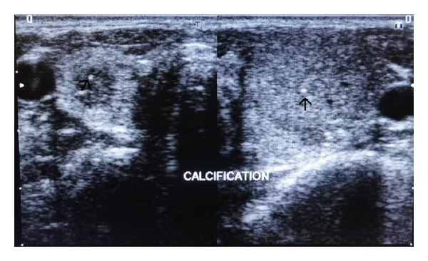 Multiple Endocrine Neoplasia_ Ocular Features image