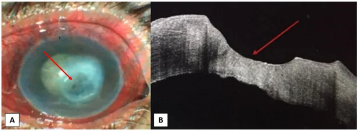 Neurotrophic Keratitis image