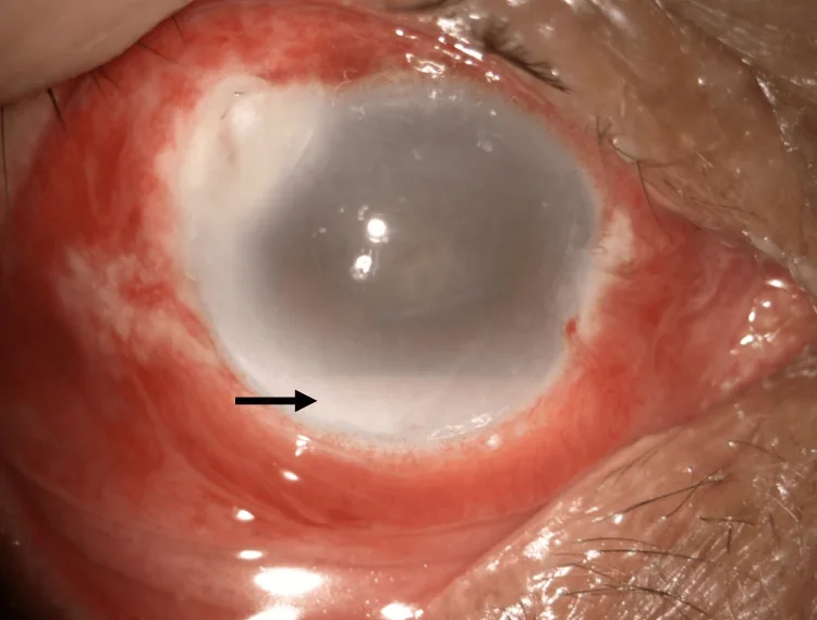 Ocular Bee Injuries image