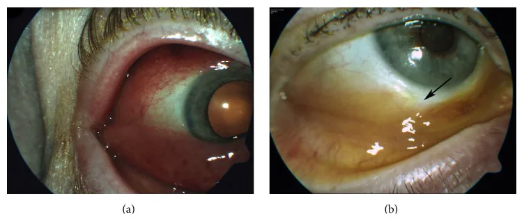 Ocular Manifestations of Cutaneous T-Cell Lymphoma image