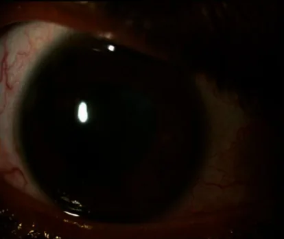 Ocular Manifestations of Hidradenitis Suppurativa image
