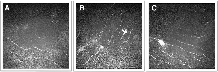 Ocular Neuropathic Pain image
