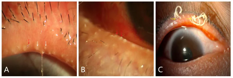 Ocular Rosacea image