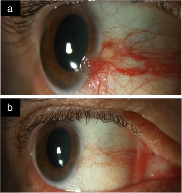 Ocular Surface Squamous Neoplasia image