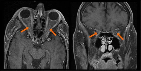 Ocular and Orbital Complications of Checkpoint Inh image