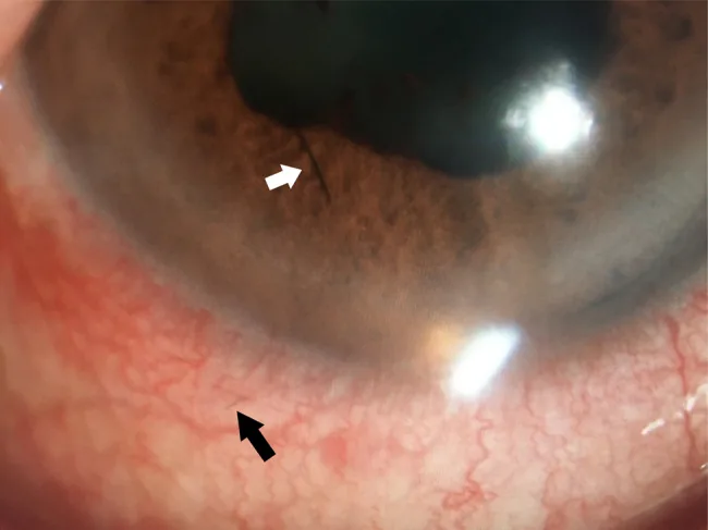 Ophthalmia Nodosa image