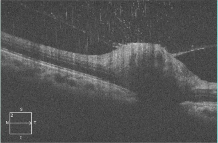 Parinaud Oculoglandular Syndrome image