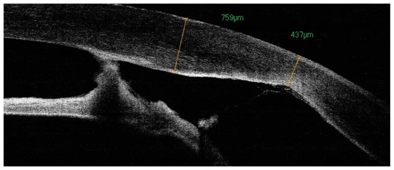 Pediatric Penetrating Keratoplasty image