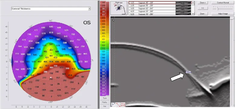 Corneal thickness map and Scheimpflug cross-sectional image of Pellucid Marginal Degeneration showing thinning of the inferior peripheral cornea