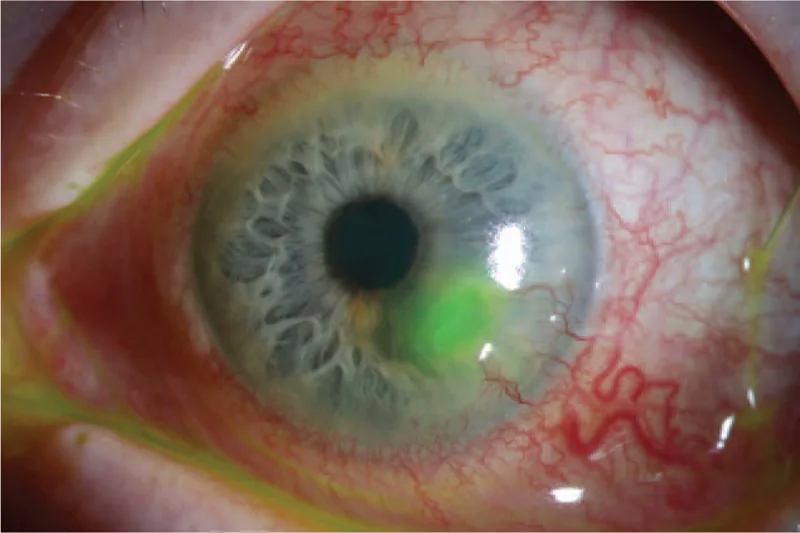 Peripheral Ulcerative Keratitis image