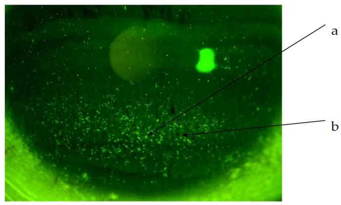 Phlyctenular Keratoconjunctivitis image
