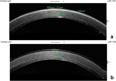 Phototherapeutic Keratectomy image