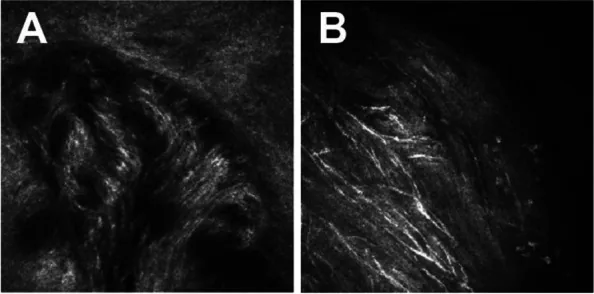 Prominent Corneal Nerves image