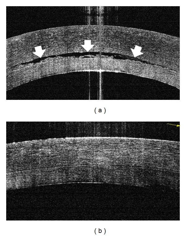 Pseudophakic Bullous Keratopathy image
