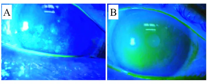 点涙点焼灼後のフルオレセイン染色像