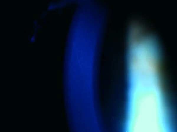 Pre-Descemet角膜ジストロフィの細隙灯写真