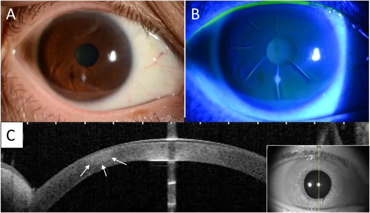 放射状角膜切開後合併症の臨床像とOCT