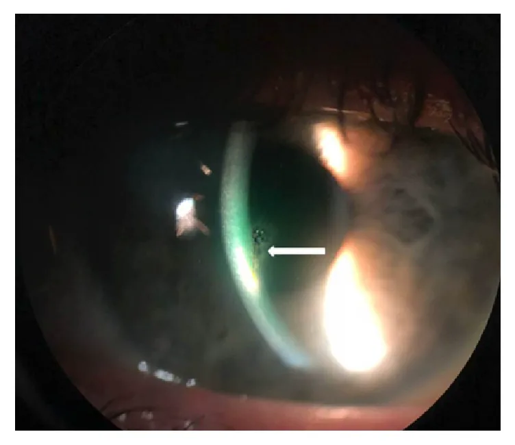 Embedded corneal foreign body on slit-lamp examination