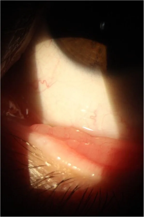 結膜rhinosporidiosisの細隙灯写真