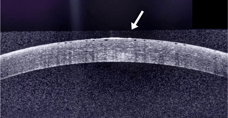 ROCK阻害薬関連角膜上皮浮腫の前眼部OCT