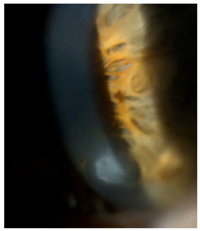 Salzmann結節変性の細隙灯写真