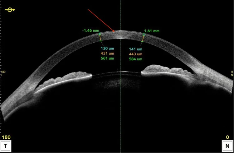 Schnyder角膜ジストロフィの前眼部OCT