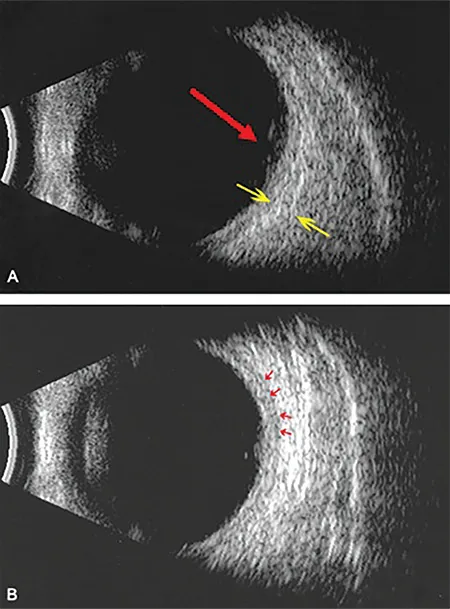 強膜炎の超音波断層像