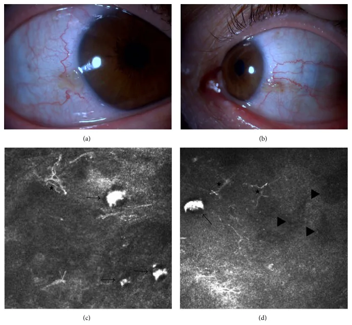 Sclerocorneaの前眼部写真と顕微鏡像