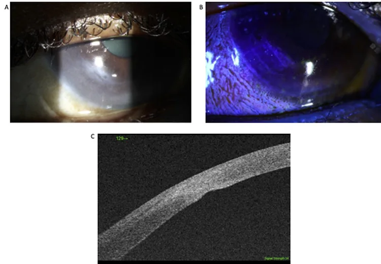 Seidel test陽性所見の臨床像