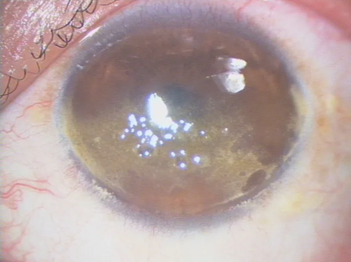 球状変性の前眼部写真