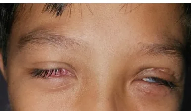 Stevens-Johnson症候群の眼表面写真