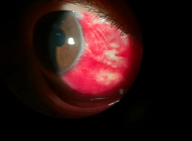 結膜下出血の細隙灯写真