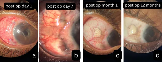 術後壊死性強膜炎の経過写真