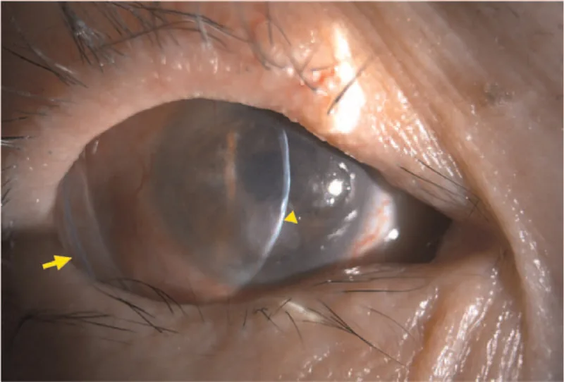 Symblepharonの前眼部写真