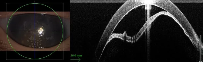梅毒性角膜炎の前眼部写真とOCT