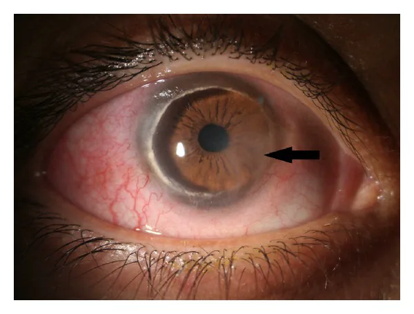 Terrien辺縁変性の細隙灯写真