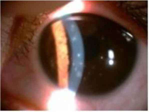 Thygeson表層点状角膜炎の細隙灯写真